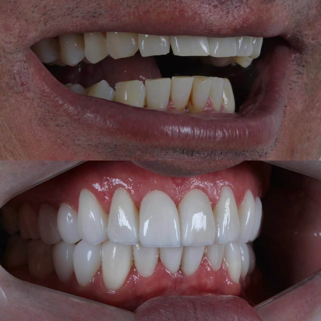 Before and after — case 1